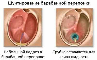 Прокол барабанной перепонки