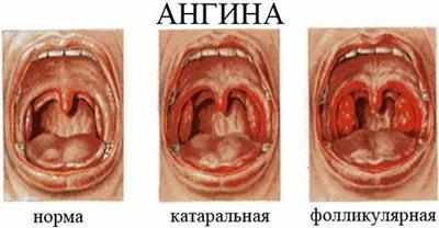 Виды ангины