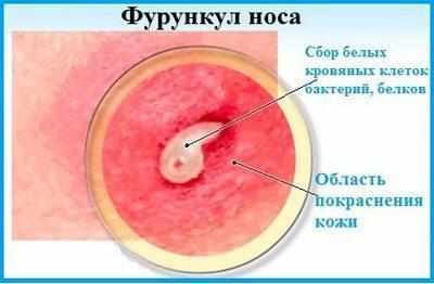 Фурункул носа