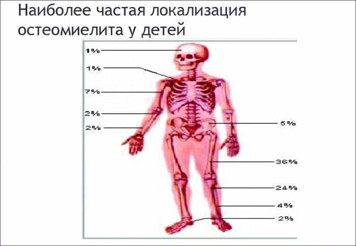 Наиболее частая локализация остеомиелита у детей.