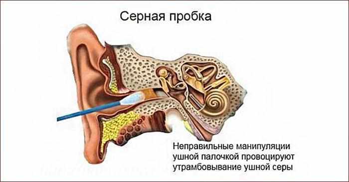 серная пробка в ухе