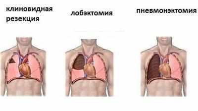 Операции на легком