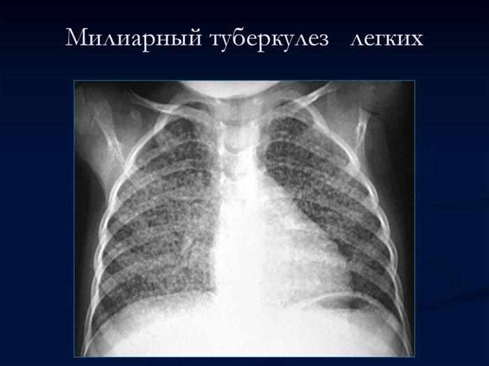 Милиарный туберкулез легких