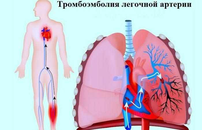 Тромбоэмболия артерии лёгкого