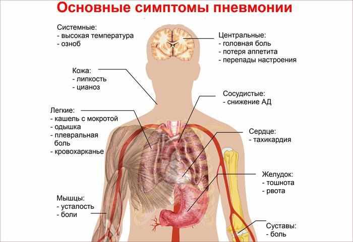 Основные симптомы пневмонии