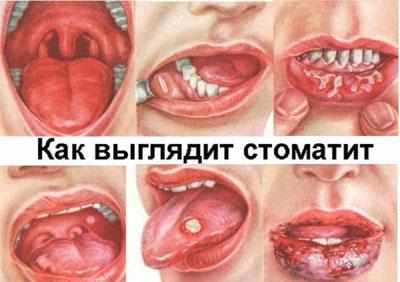 Проявление стоматита