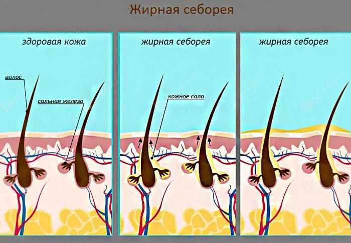 как устроена себорея