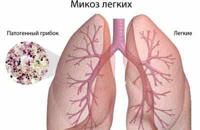 Микоз легких