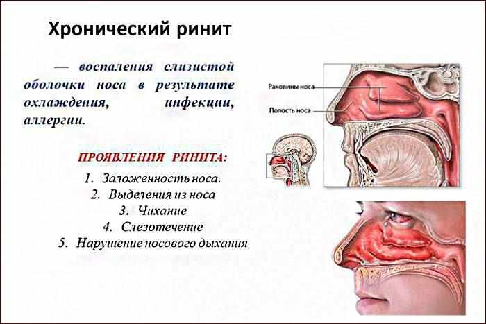 симптомы хронического ринита