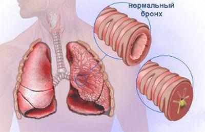 Бронхи при воспалении