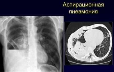 Аспирационная пневмония на рентгене