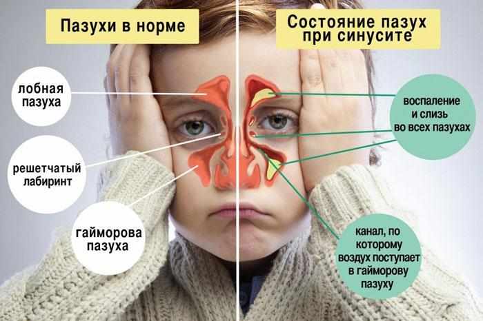 Признаки синусита у ребенка