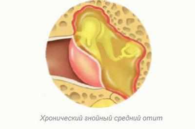 Гнойный отит