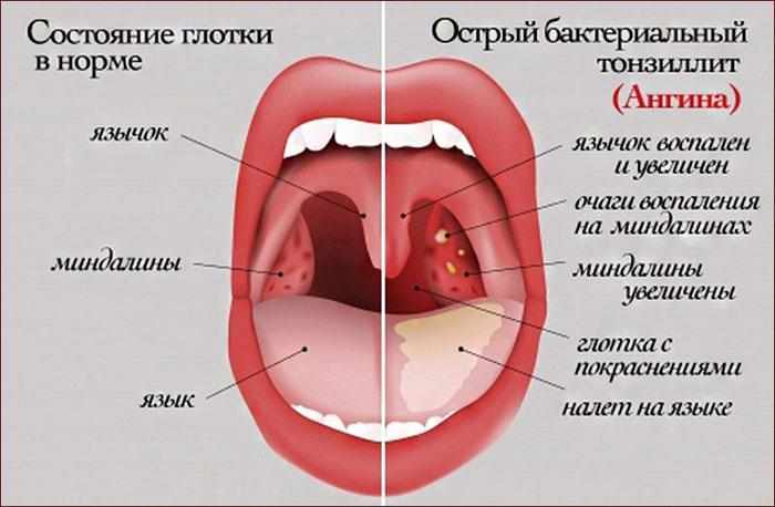 Симптомы ангины