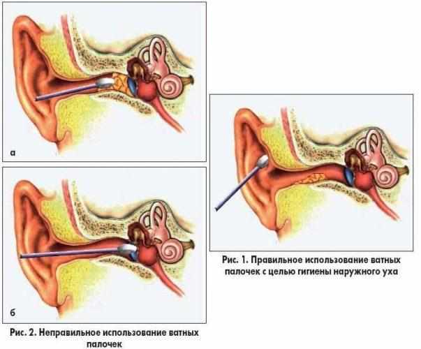 Как чистить уши