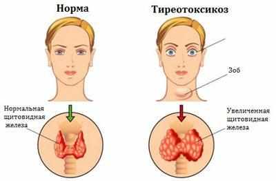 Проявление тиреото