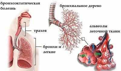 Бронхоэктатическая болезнь