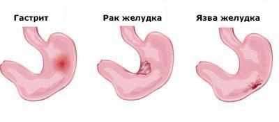 Болезни желудка