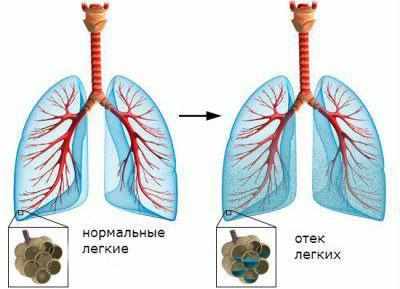 Отек легких