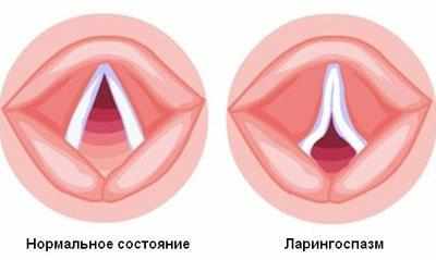 Связки при лорингоспазме