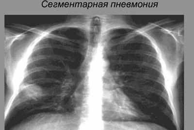 Сегментарная пневмония