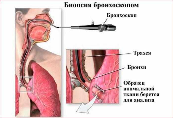 Принципы бронхоскопии