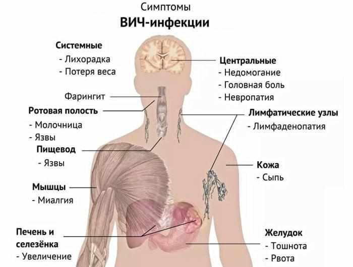 Симптомы ВИЧ-инфекции