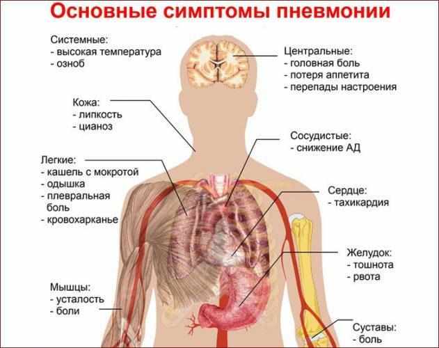 Симптомы пневмонии