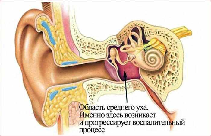 продутое ухо воспаление