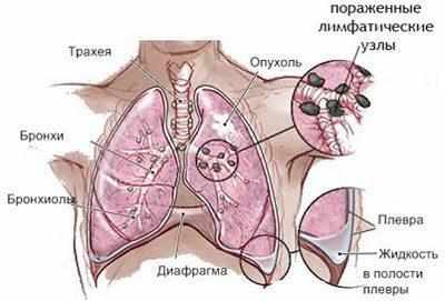 Саркома легких