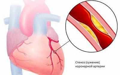 Проявление стенокардии