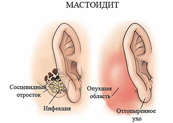 Симптомы мастоидита