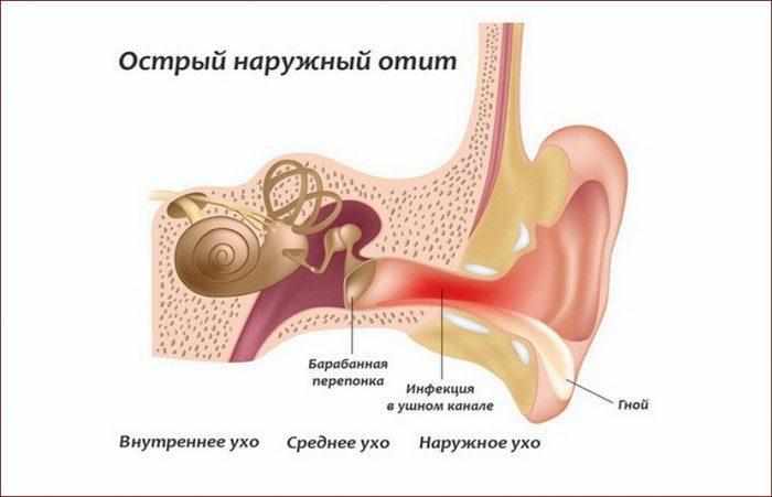 Наружный отит