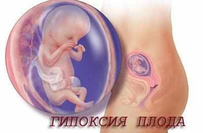 Гипоксия плода