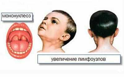 Мононуклеоз у ребенка