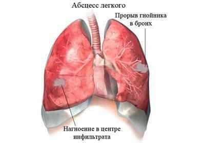 Абсцесс легкого