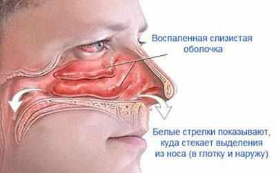 Насморк при синусите