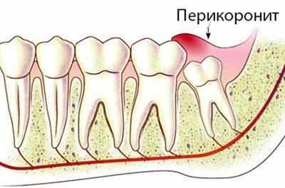 Возникновение перикоронита