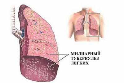 Милиарный туберкулёз
