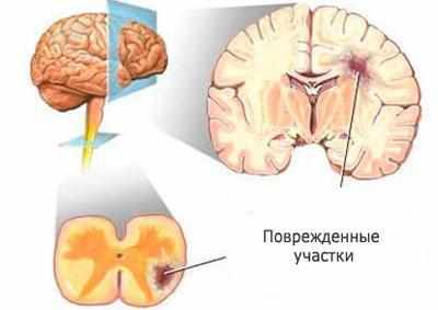 Мозг при рассеянном склерозе