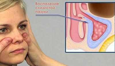 Воспаление пазух носа при синусите