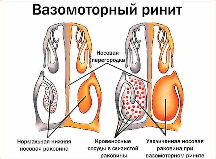 специфика вазомоторного ринита
