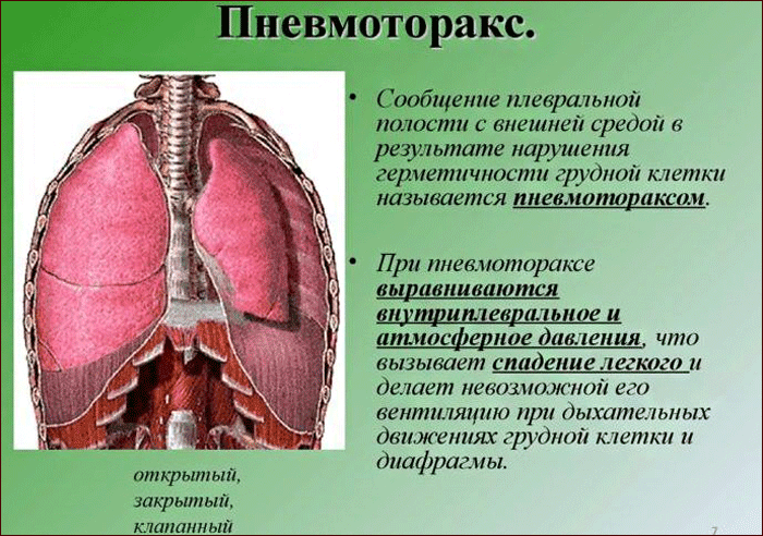 что такое пневмоторакс