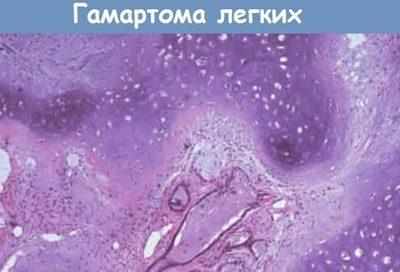 Гамартома под микроскопом