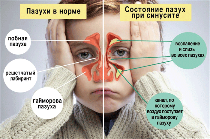 симптомы синусита