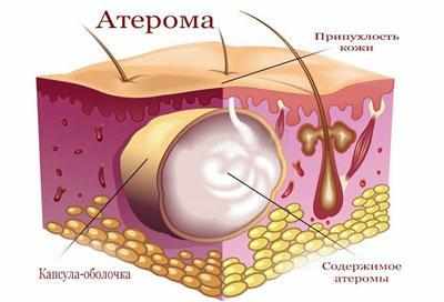 Образование атеромы