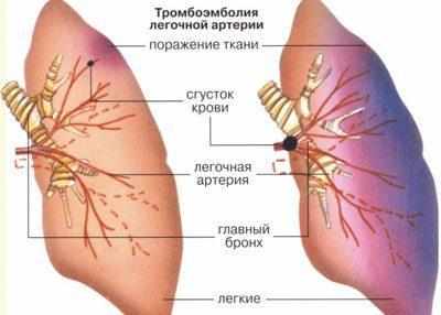 Тромбоэмболия легочной артерии