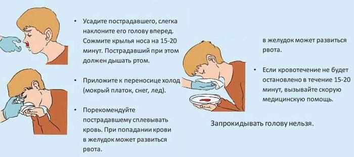 Помощь при кровотечении из носа
