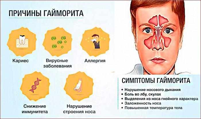 Симптомы гайморита