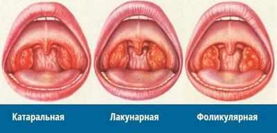 Виды ангины